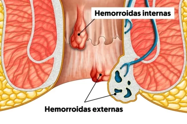 Hemorroidas-internas_-o-que-sao-principais-sintomas-e-graus